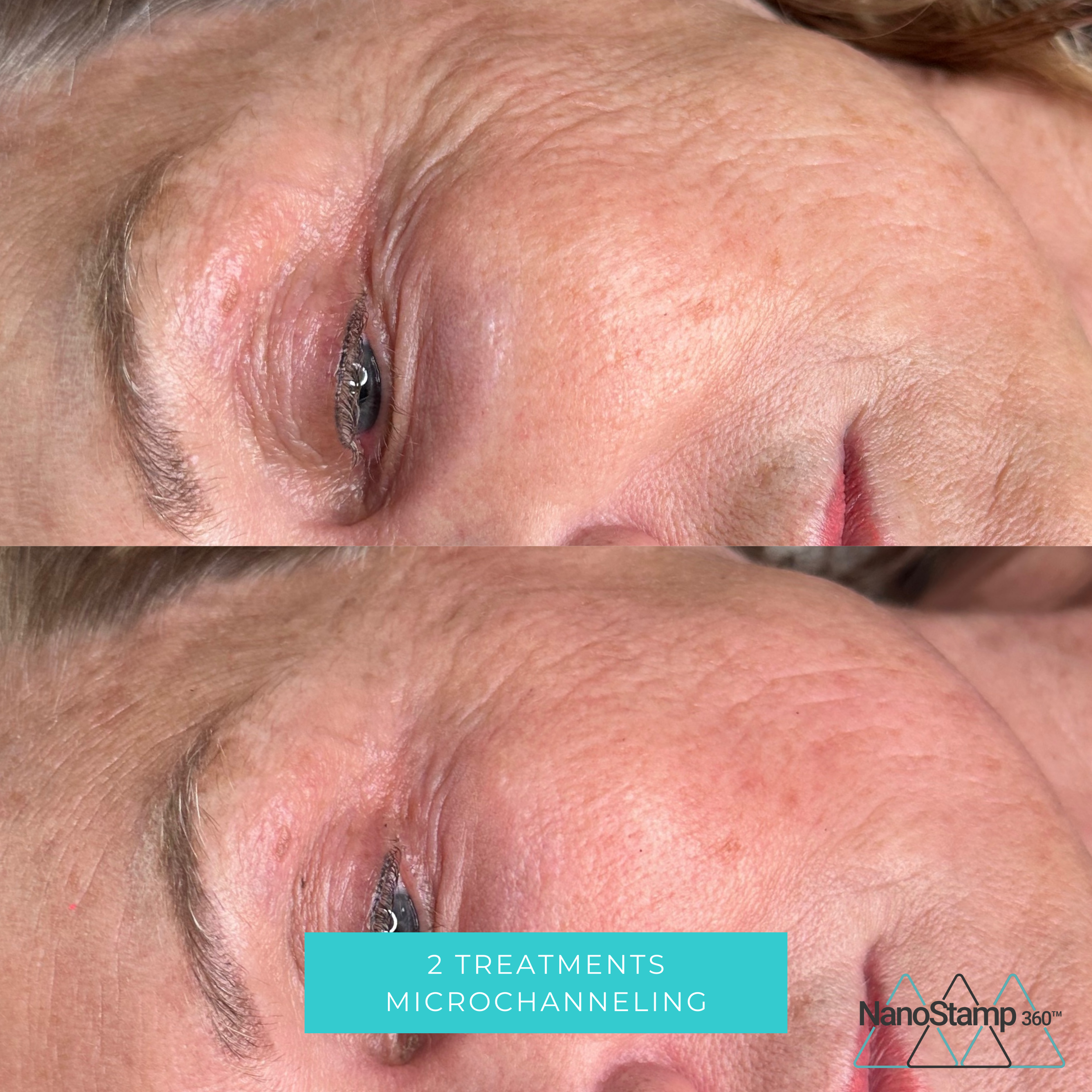 Close-up view of a person's face showing the area around the eye and cheek before and after two microchanneling treatment sessions, with a caption indicating the treatments performed.