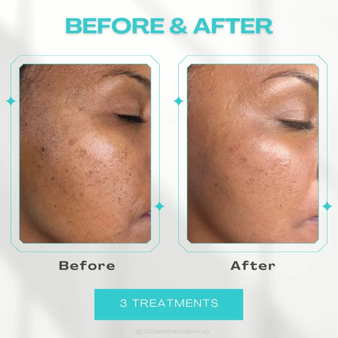 Side-by-side comparison of a person's cheek before and after three skin treatments, showing clearer skin with reduced pores and acne scars.