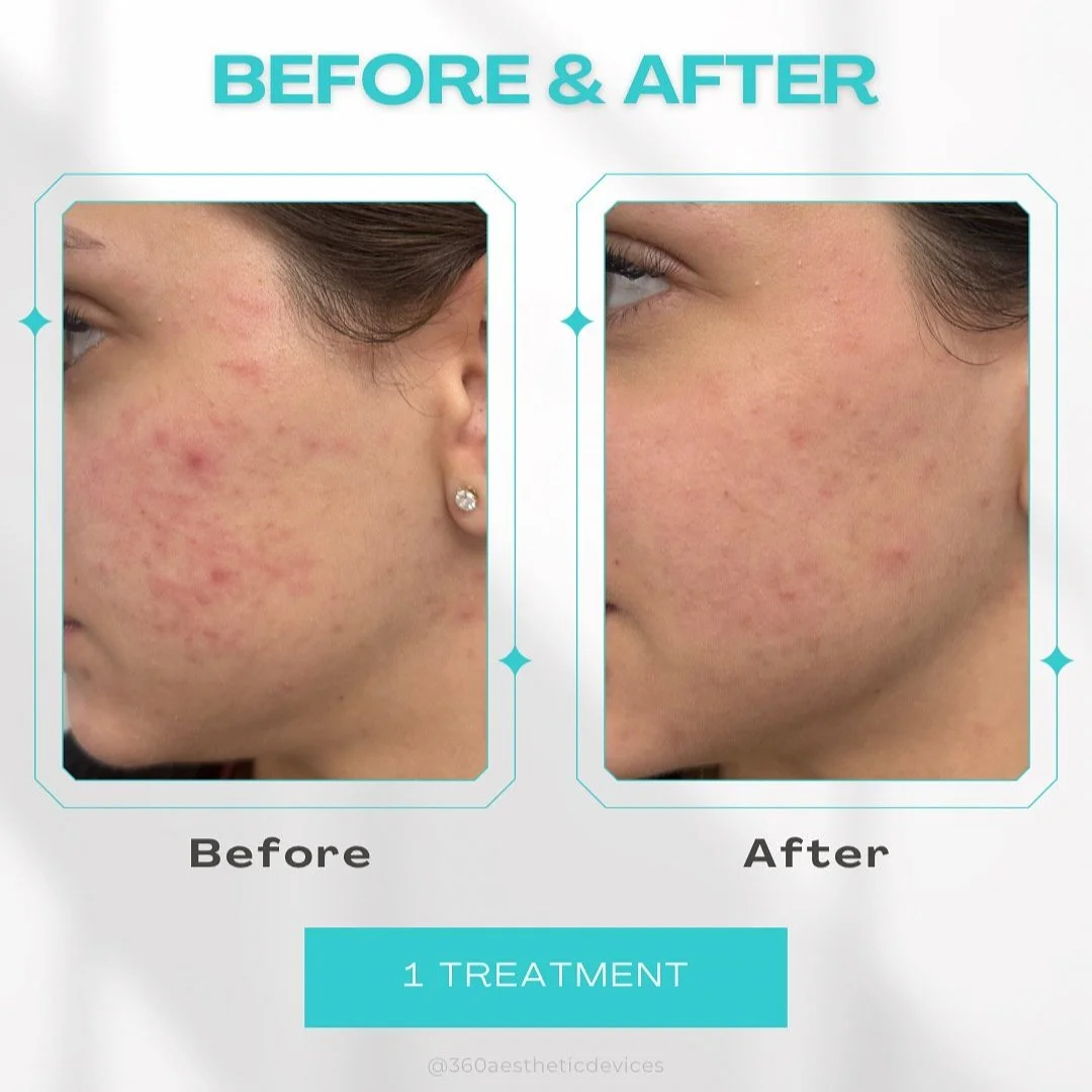Side-by-side comparison of a woman's cheek showing improvement in acne and redness after one skin treatment, with before and after labels at the top.