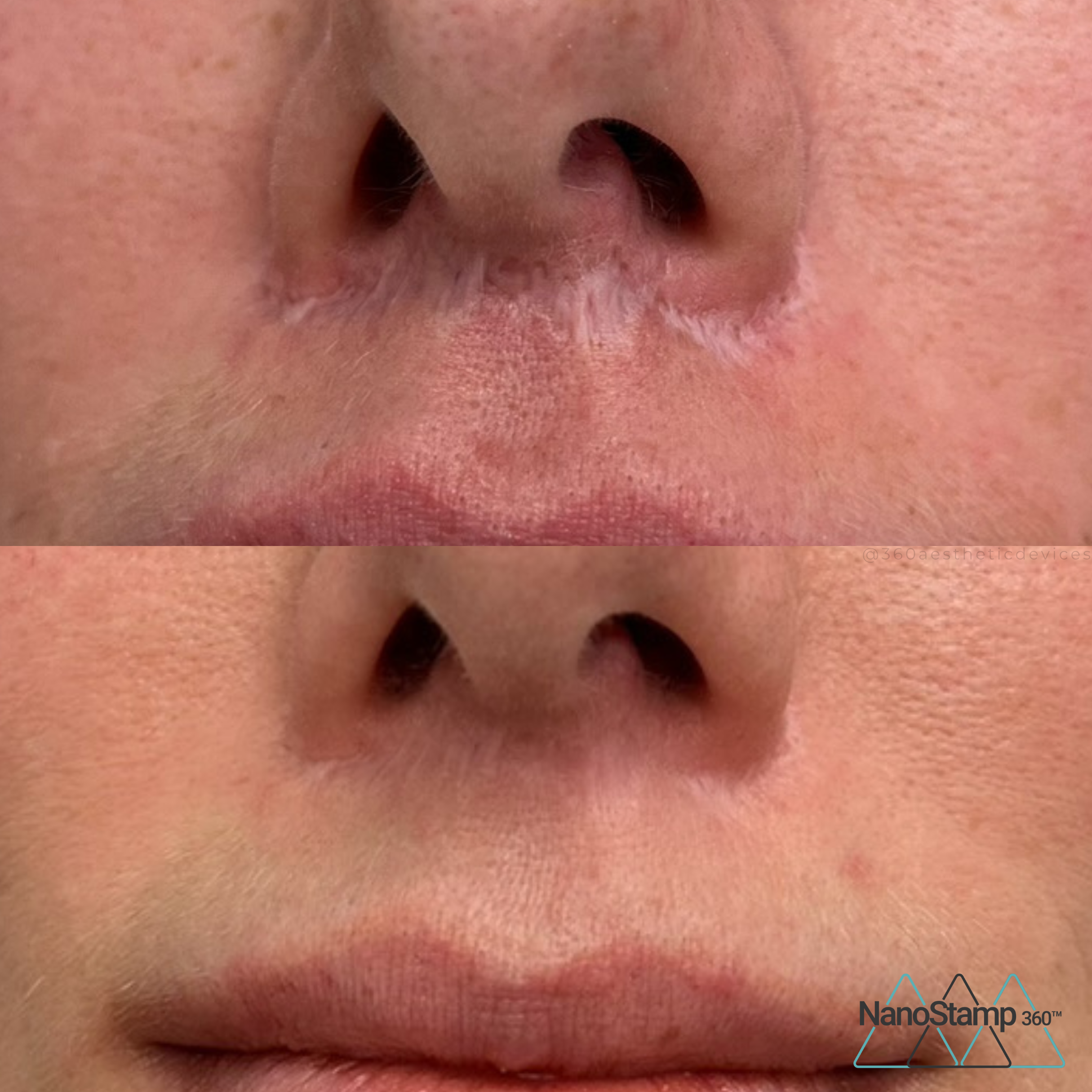 Close-up before and after images of a person's nose and upper lip area showing improvement in skin texture and appearance.