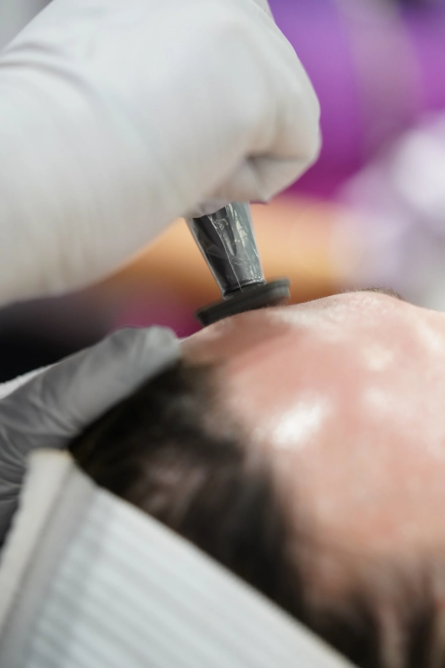 A close-up of a cosmetic procedure, with a gloved hand injecting a substance into a person's forehead with a syringe.