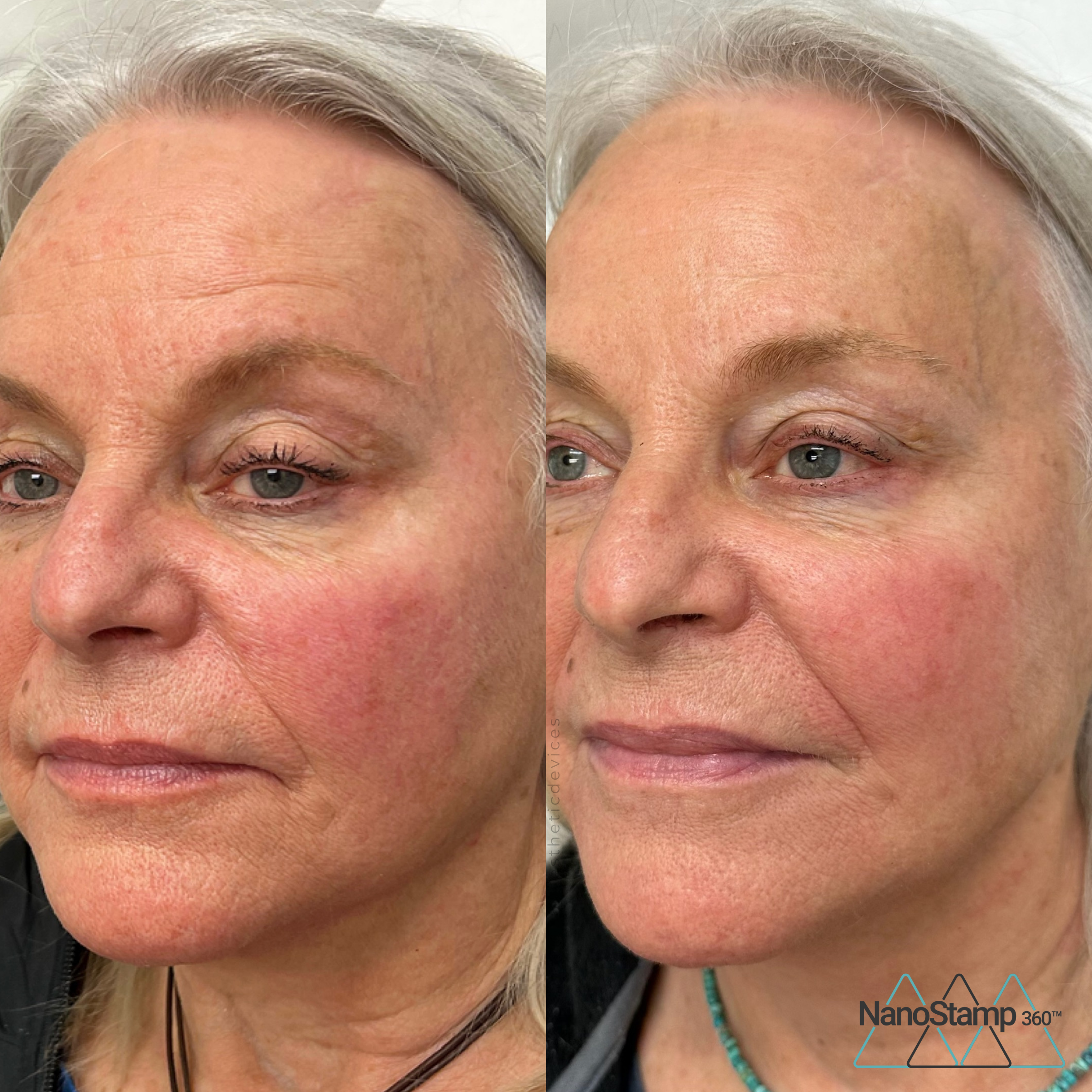 Side-by-side comparison of a woman’s face before and after a skincare treatment, showing improved skin texture and reduced redness.