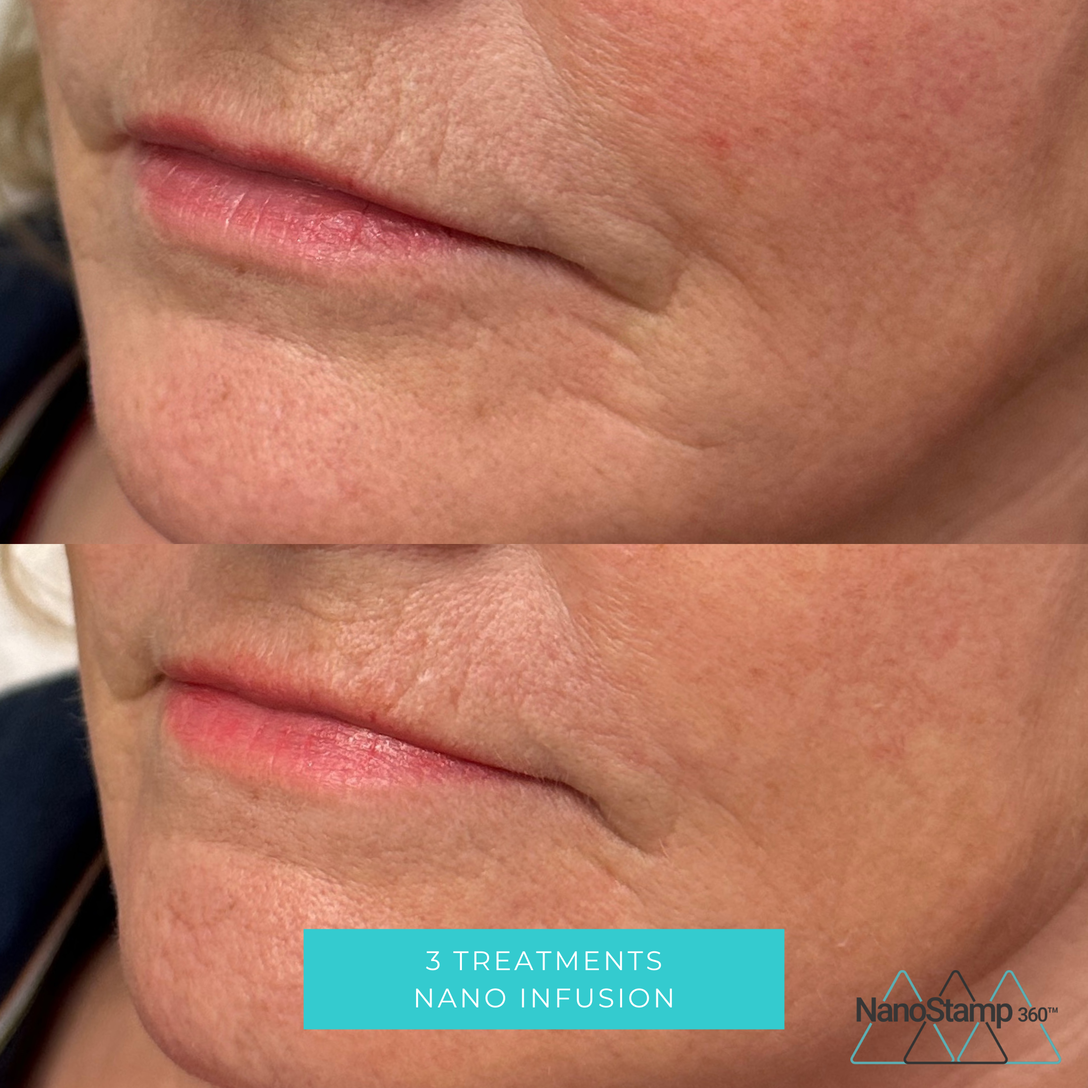 Before and after images of a person's lips and surrounding skin, showing improved skin texture following three nano infusion treatments, with a label indicating '3 Treatments Nano Infusion' and a NanoStamp logo.