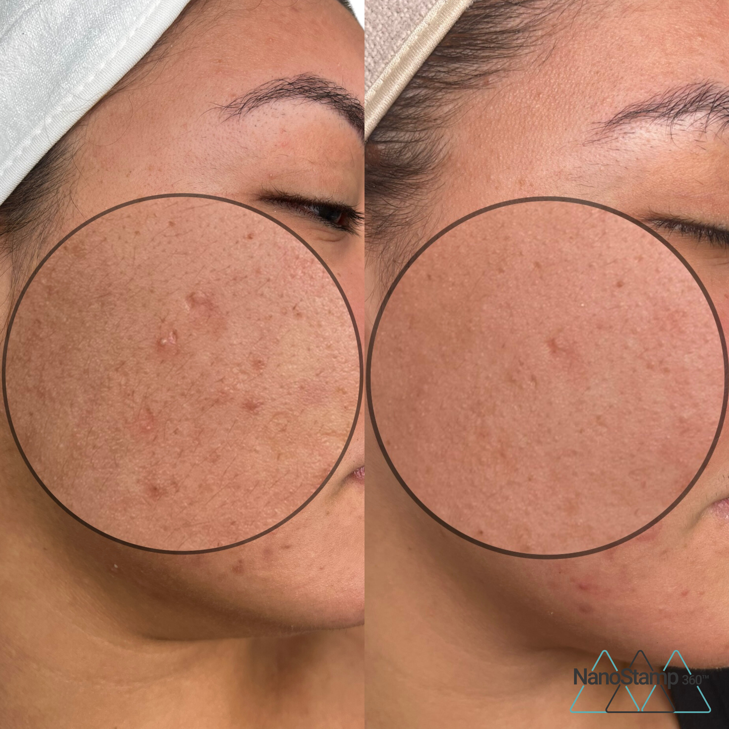 Before and after close-up images of a person's cheek showing reduction in acne scars and skin texture improvement.