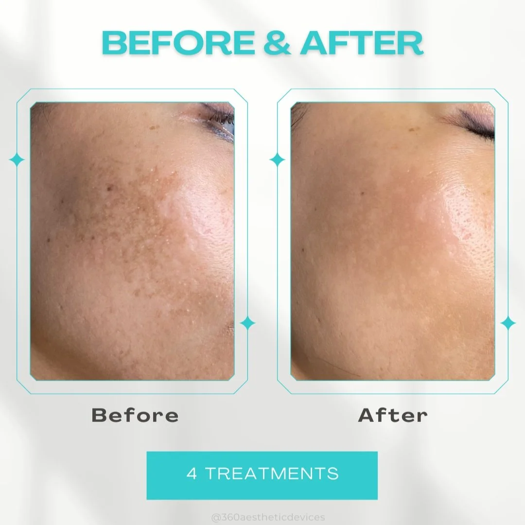 Side-by-side comparison of a person's cheek showing a significant reduction in dark spots and skin blemishes after four treatments, labeled 'Before & After'.