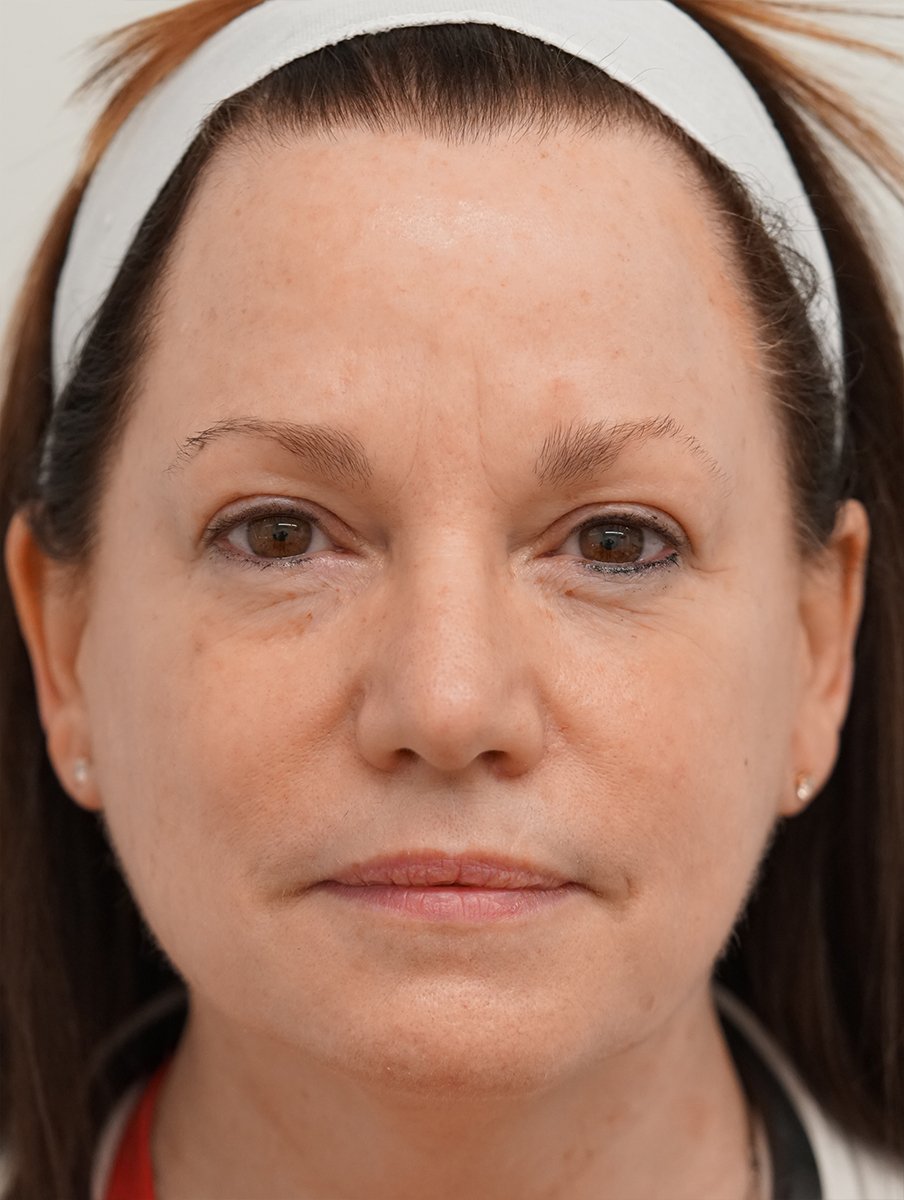 Close-up of a person wearing a white headband, with neutral expression.