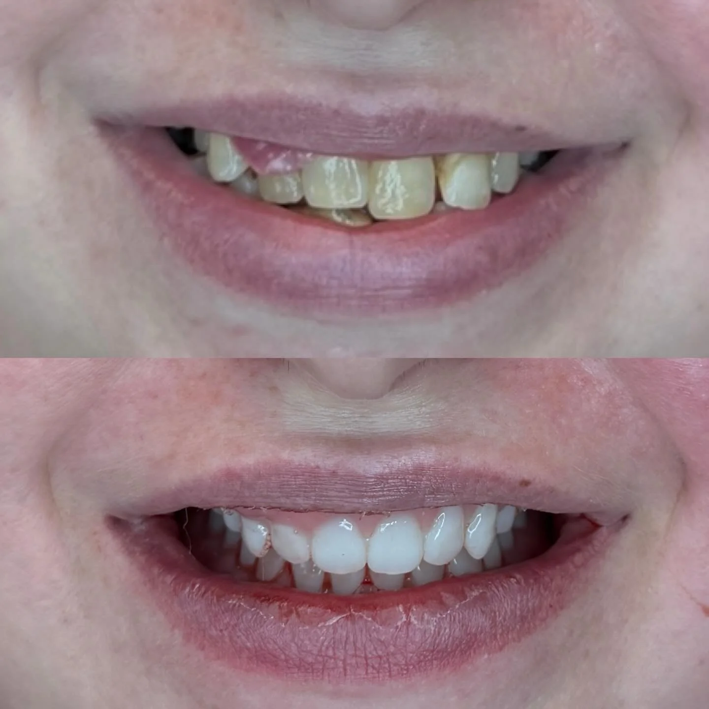 Many people don&rsquo;t realize this is possible 👇

Full mouth extractions + immediate dentures means:
✔ Teeth removed
✔ Dentures placed the same day
✔ No time without teeth

Healing happens with the denture in place, which helps guide tissue and re