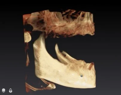 This is what resilience looks like.
Prior to undergoing life-saving triple bypass surgery, this patient was required to remove severely infected teeth before he could even qualify for treatment.

What you&rsquo;re seeing here is significant bone loss