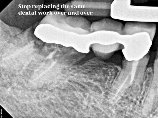 Great dentistry always aims to preserve and maintain natural teeth whenever possible.

But when existing restorations begin to fail&mdash;and long-term stability becomes a concern&mdash;there are additional options to consider.

In this case, a faili