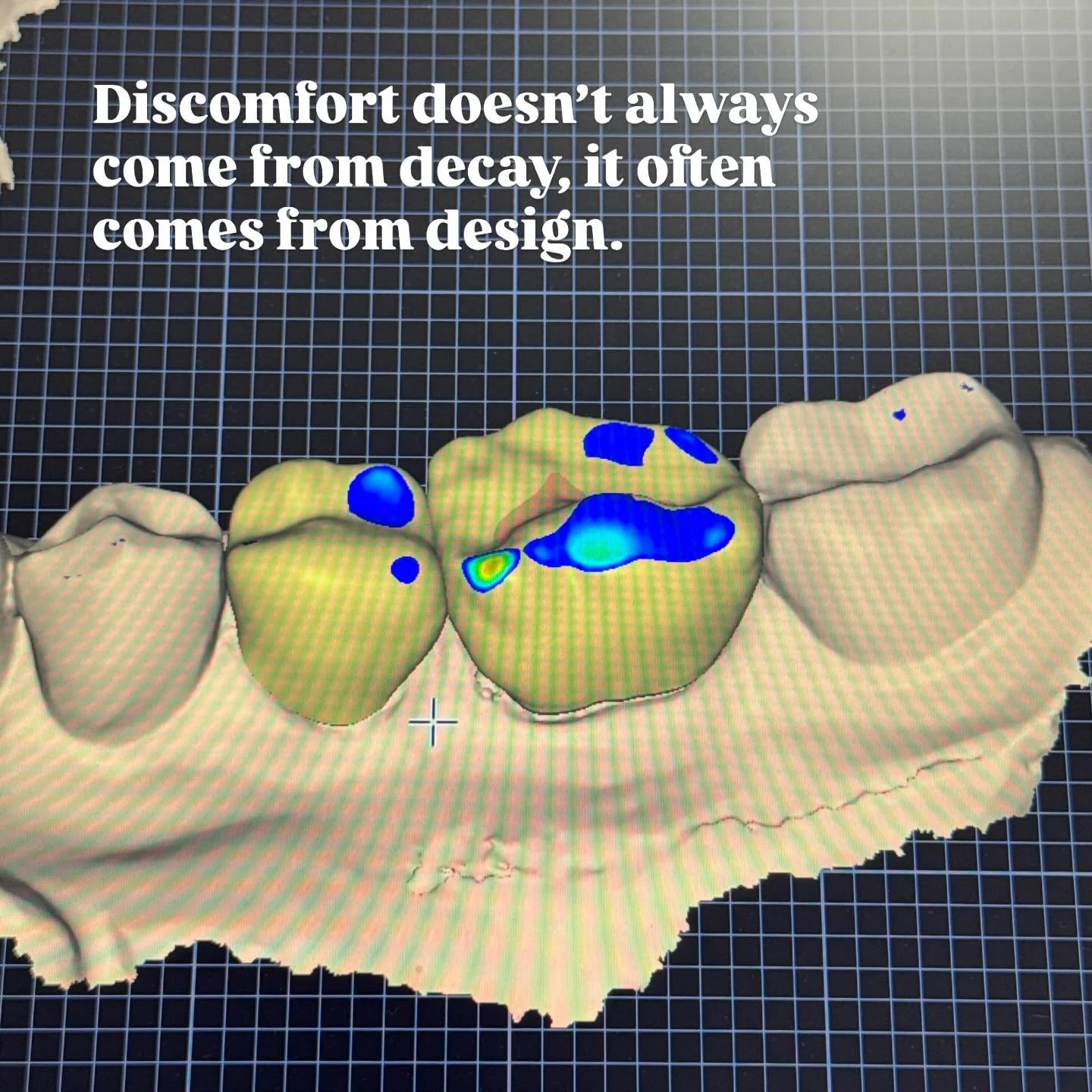 This patient was experiencing a persistent food trap between her back teeth due to recession, tooth positioning, and a poorly contoured existing crown. The contact was too light, and the emergence profile didn&rsquo;t properly support the surrounding