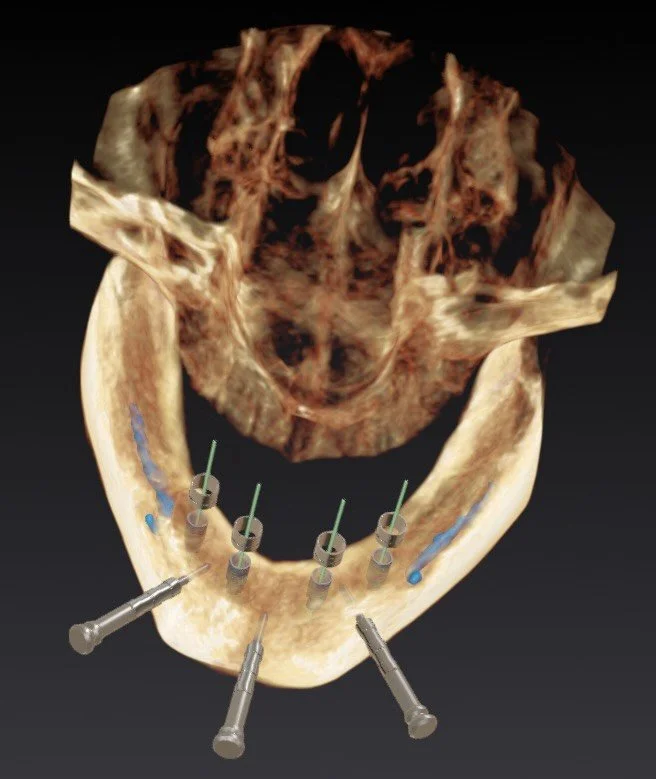 It&rsquo;s completely normal to feel apprehensive when you first hear about surgery like this. I&rsquo;d feel the same way too. 🤍

But the big picture and long term function will be worth it! As far as your implant procedures, you really don&rsquo;t