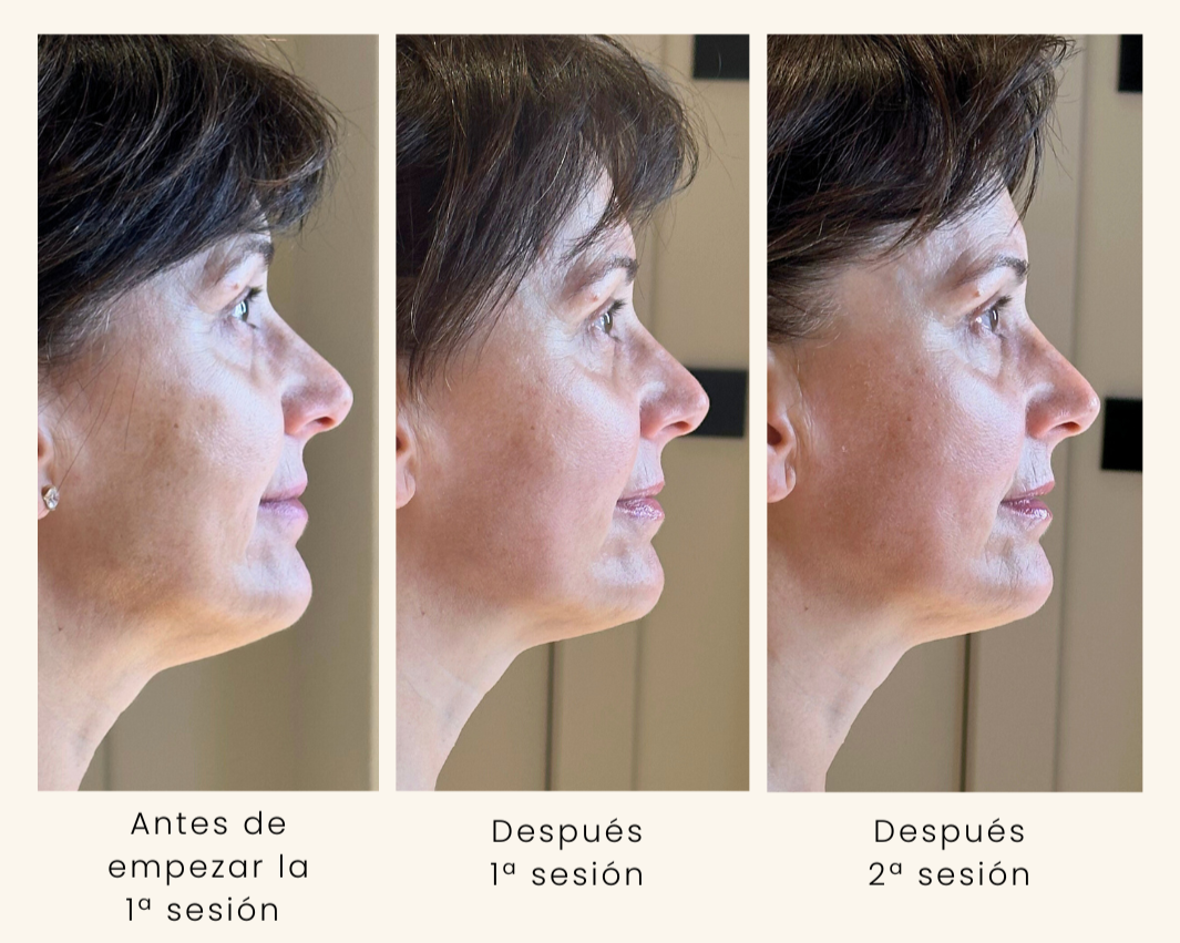 tratamientos faciales en zaragoza