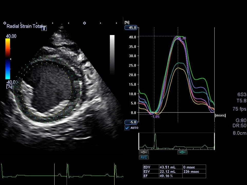 An echocardiogram showing measurements of blood flow