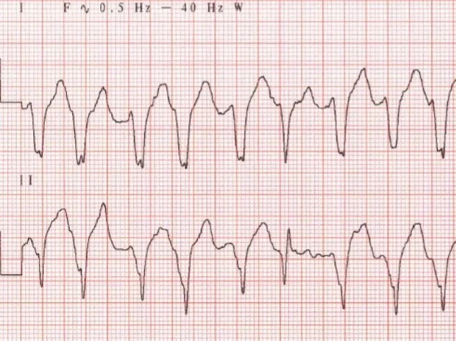 Electrocardiogram (ECG) tracing showing irregular, rapid heartbeats with varying wave patterns on grid paper.