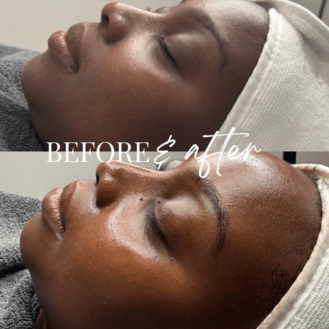 Another beautiful result

This lactic acid peel left her skin looking healthy, refreshed, and glowing &mdash; proof that you don&rsquo;t need an active concern to benefit from professional skin treatments. Sometimes it&rsquo;s simply about giving you