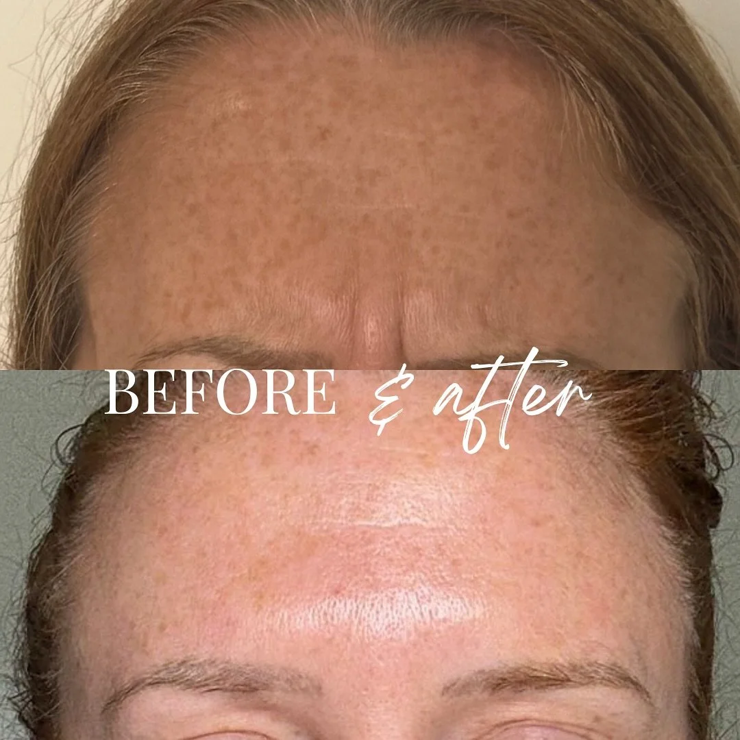 Another beautiful upper face anti-wrinkle treatment result. One of the most common treatments we offer. With Christmas around the corner, don&rsquo;t forget to book in advance for your anti-wrinkle treatment.

To learn more, click link in the bio

#a
