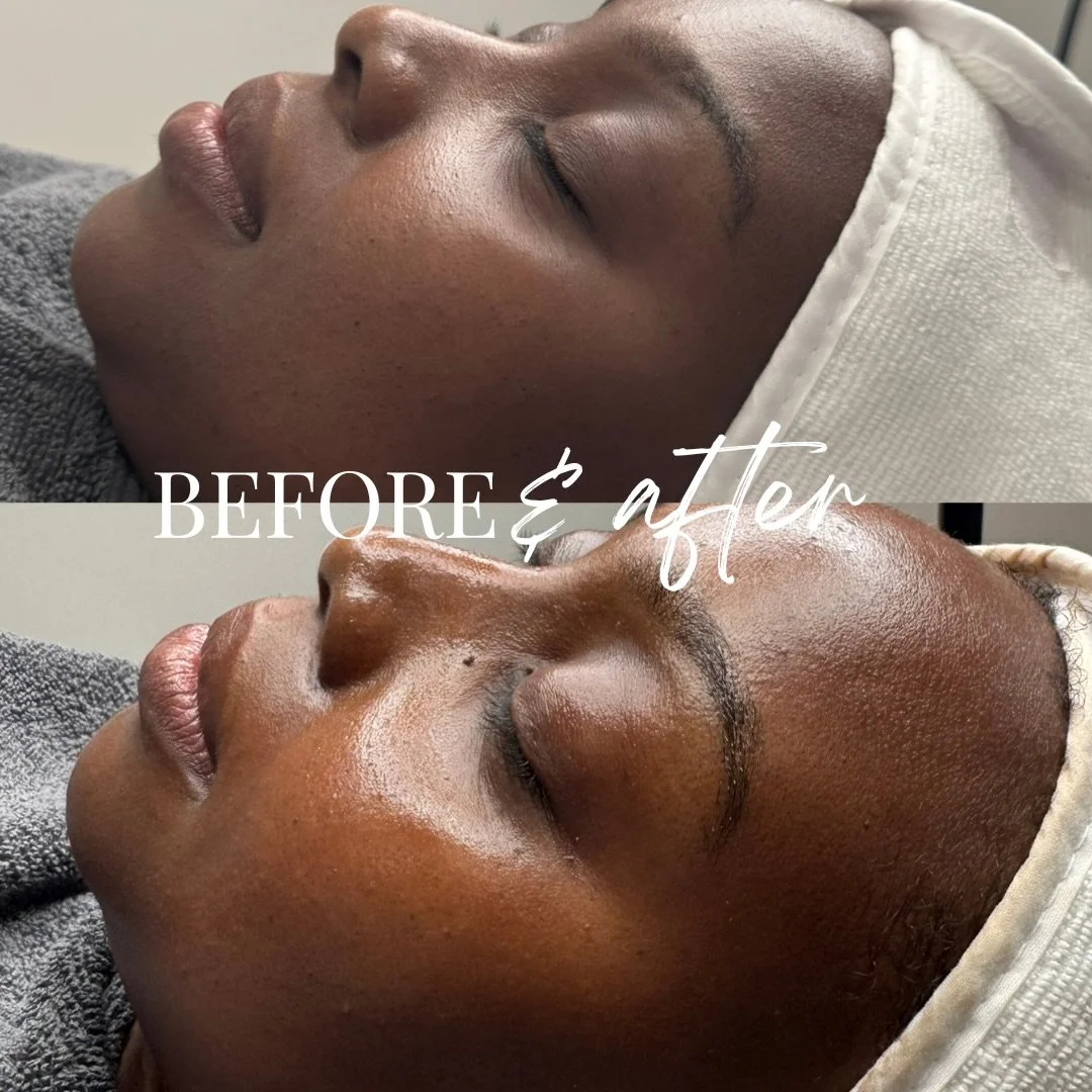 This client came to me wanting her skin to look:
&bull; Brighter
&bull; More hydrated
&bull; And refreshed

No dramatic changes.
No harsh treatments.
Just restoring hydration, supporting the skin barrier, and working with her skin, not against it.

S