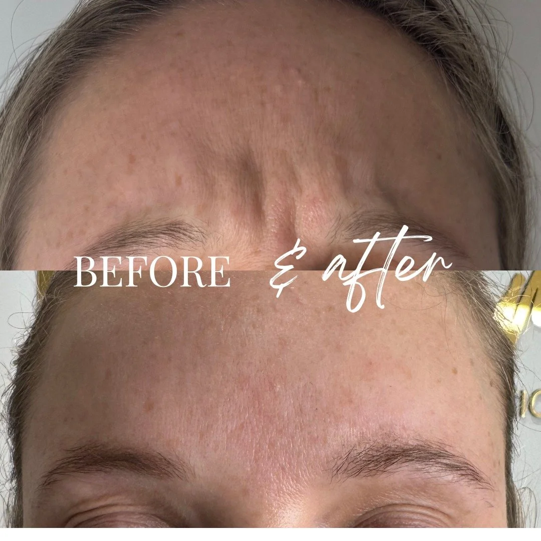 Anti-wrinkle isn&rsquo;t always about correcting deep lines &mdash; sometimes it&rsquo;s about preventing them.
This client had lines on movement but no static lines at rest, making her the perfect candidate for preventative treatment. We treated thr