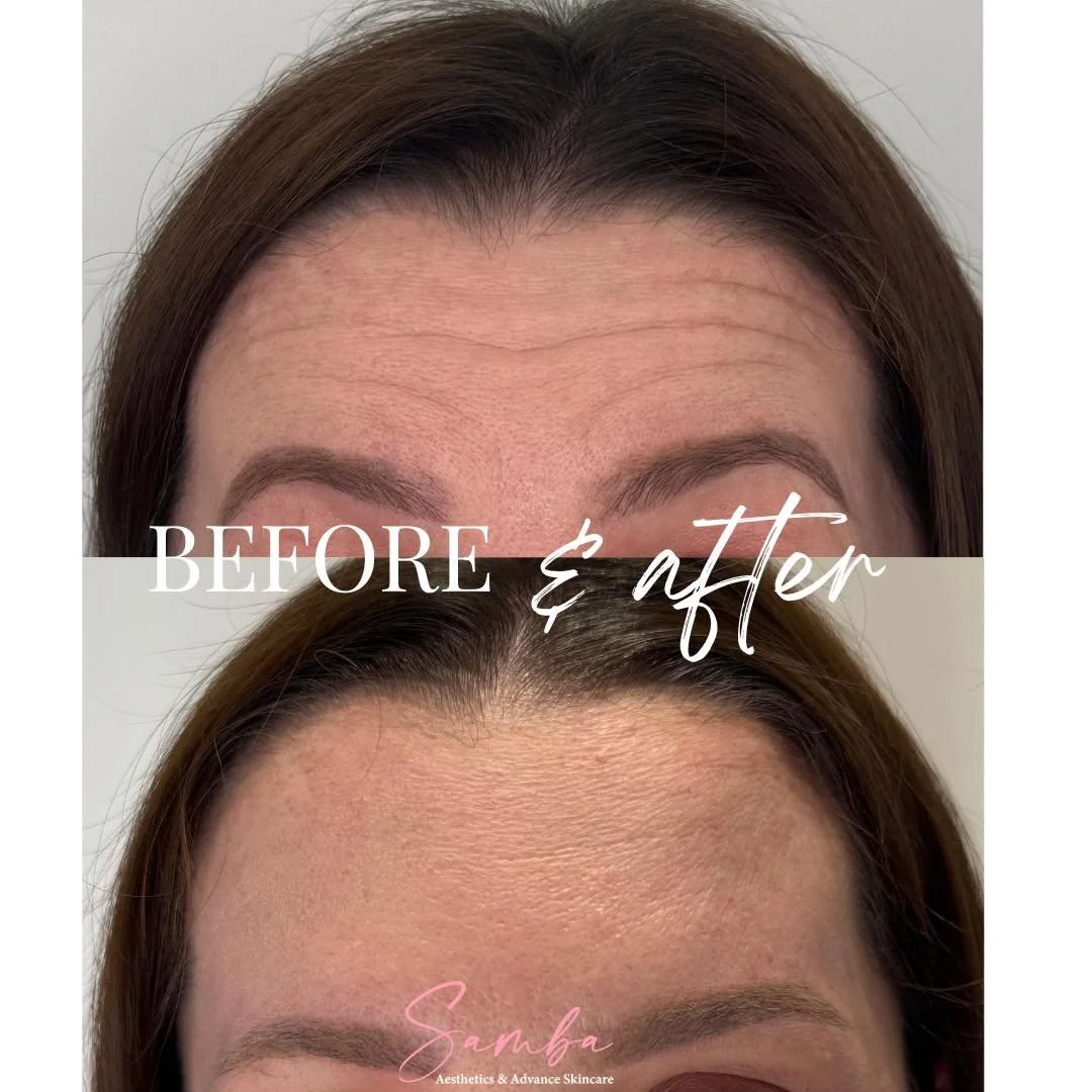 This is what anti-wrinkle treatment should look like.

Smooth, natural, rested. Still completely herself, just without the lines that were bothering her.

My client was more than happy to share these results because this is exactly the point. You can