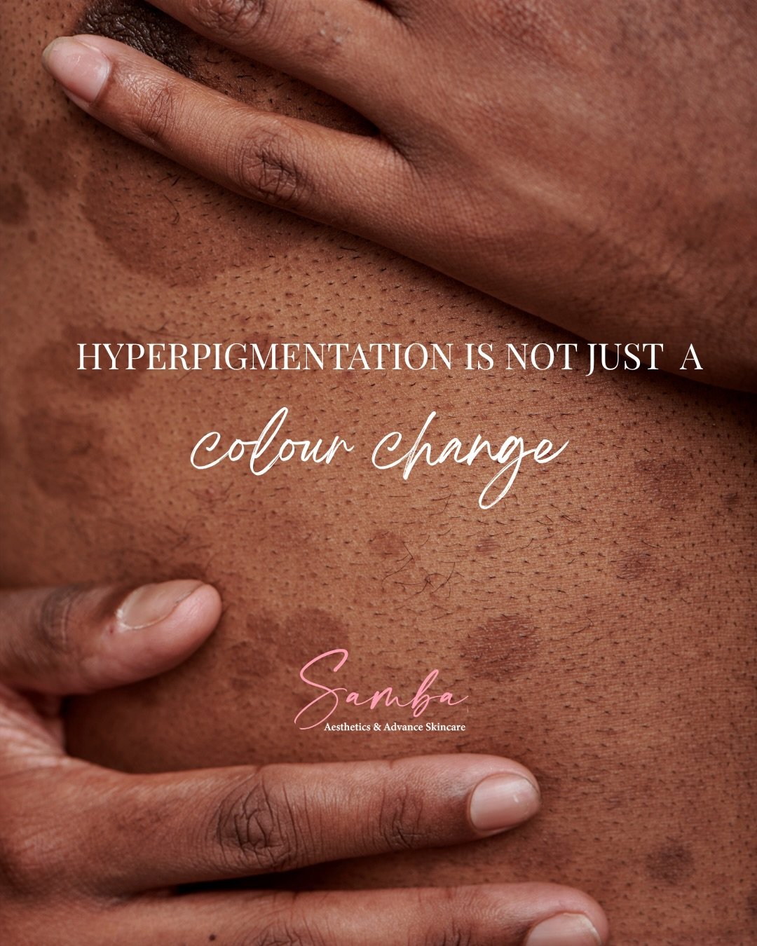 Hyperpigmentation isn&rsquo;t just about the dark patches you can see. 

It&rsquo;s about why they&rsquo;re there in the first place.
Sun damage, hormones, inflammation, injury, they all show up on the skin differently, and they all need a different 