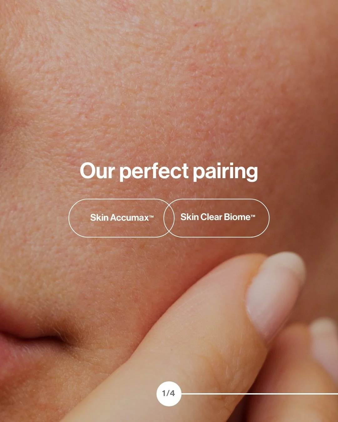 It&rsquo;s Acne Awareness Month and if you&rsquo;ve been struggling with your skin, this is your sign to start treating it from the inside out.

Skin Accumax works on problem skin by synergising vitamins A, C and E to clarify your complexion at a dee
