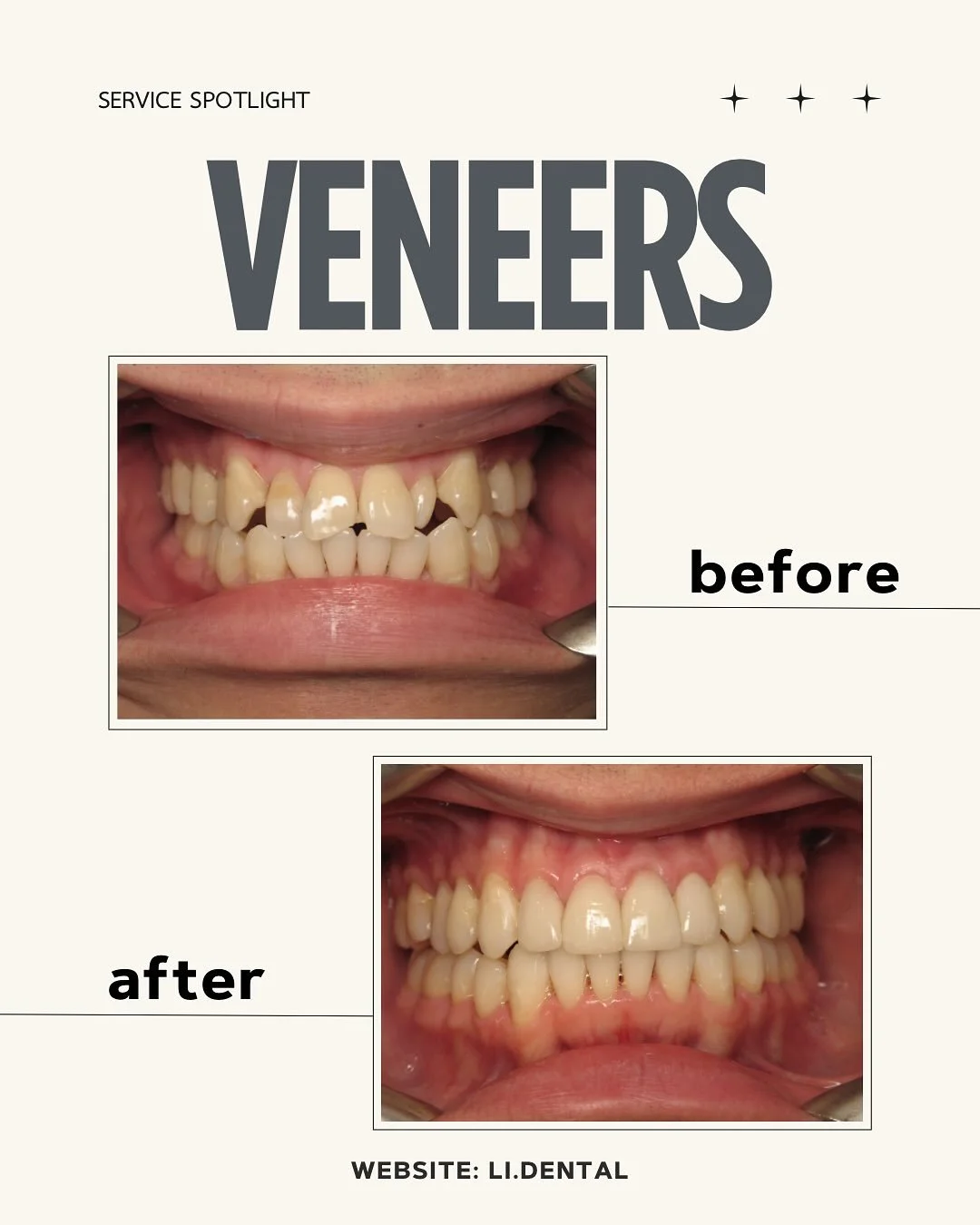 Veneers are one of the most effective ways to enhance your smile by correcting chips, gaps, discoloration, and asymmetry with natural-looking results.

Made from ultra-thin porcelain or composite, they&rsquo;re carefully bonded to the front of your n