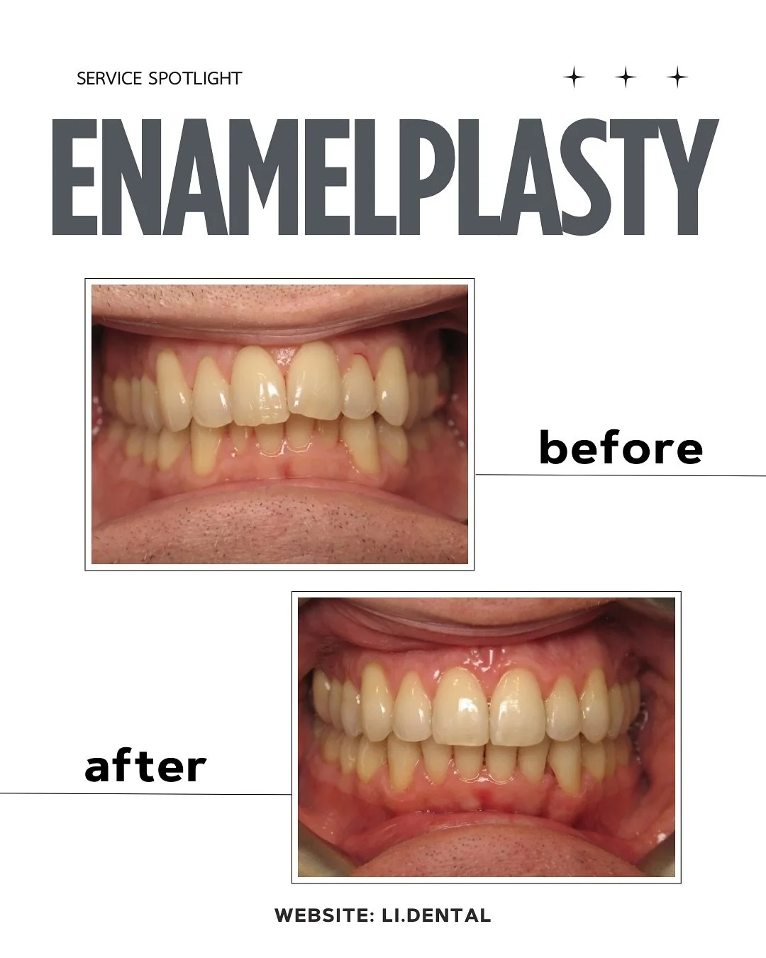 Enamelplasty is a quick, minimally invasive way to perfect your smile by gently removing small amounts of enamel to:
&bull; Smooth rough edges
&bull; Even out tooth length
&bull; Refine minor shape irregularities

No downtime, no recovery - and done 