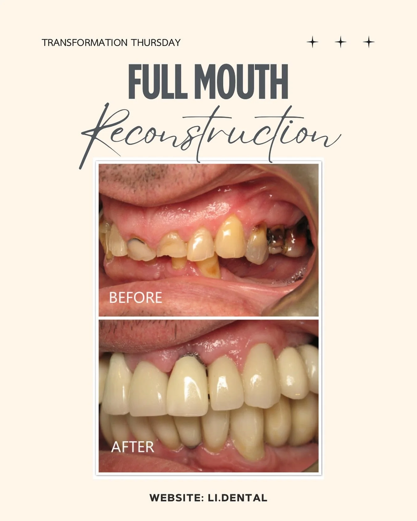 This smile transformation was a 5-year journey, but much needed to restore both function and aesthetics.

Here&rsquo;s what Dr. Li did:

 ✔️ Placed implants on the lower molars
 ✔️ Extracted upper teeth due to damage
 ✔️ Placed implants on the upper 