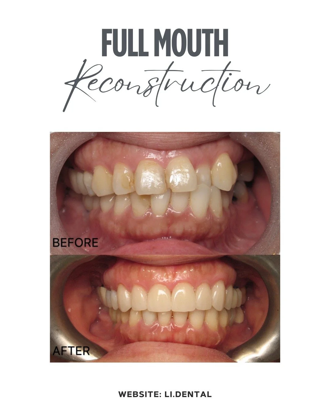 Over the course of several years, Dr. Li completely transformed this patient&rsquo;s smile - improving its health, alignment, and aesthetics.

Treatment plan included:
✔️ Implants to replace missing teeth and restore chewing function
✔️ Fillings and 