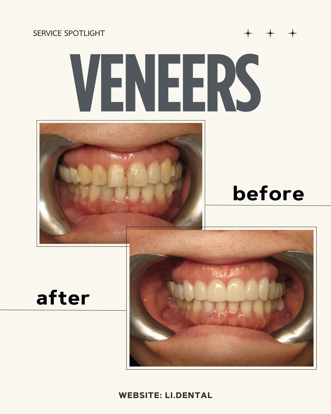 Last week, we shared this patient&rsquo;s full mouth reconstruction journey that included Invisalign and implants to rebuild the foundation.

Now we&rsquo;re taking a closer look at the final step: veneers.
Once the bite and alignment were in place, 