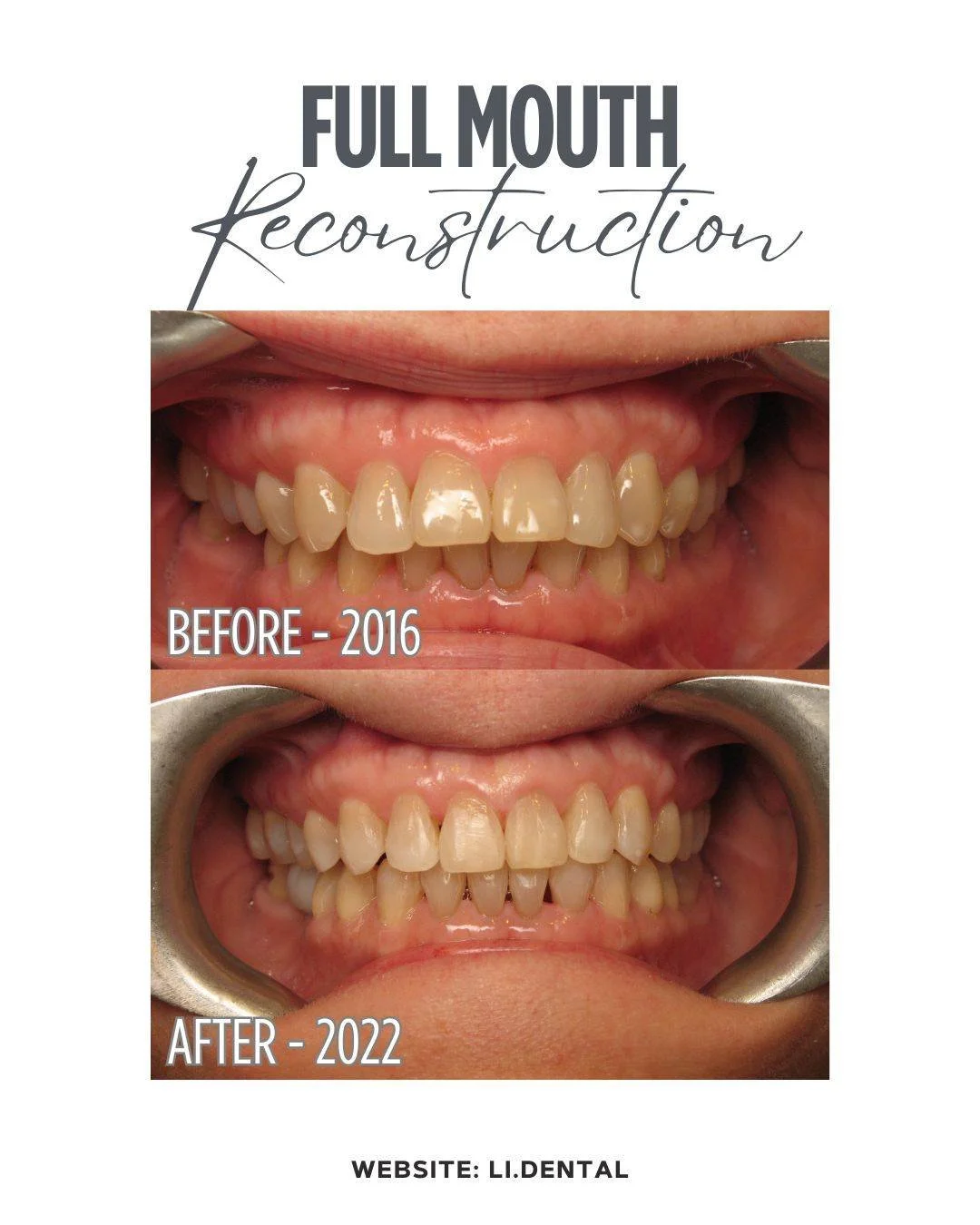 In six years, this patient&rsquo;s smile transformed significantly.

The patient came to see Dr. Li for a missing tooth and a loose filling. During the initial exam, Dr. Li identified additional concerns for periodontal disease and severe grinding (b