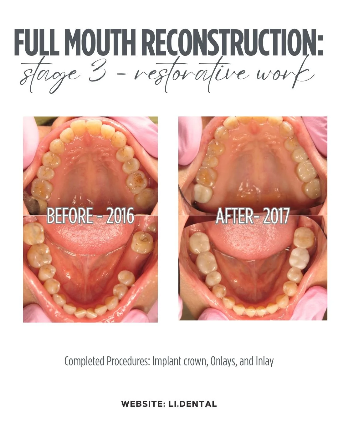 Stage 3 - Restoration:
Dr. Li fitted a crown onto the implant (placed in stage 1) and used onlays and an inlay to restore vertical dimension lost to severe grinding.

❓ Want to learn more? Stay tuned for Stage 4 - Refinement.

Call us at 212-223-3005