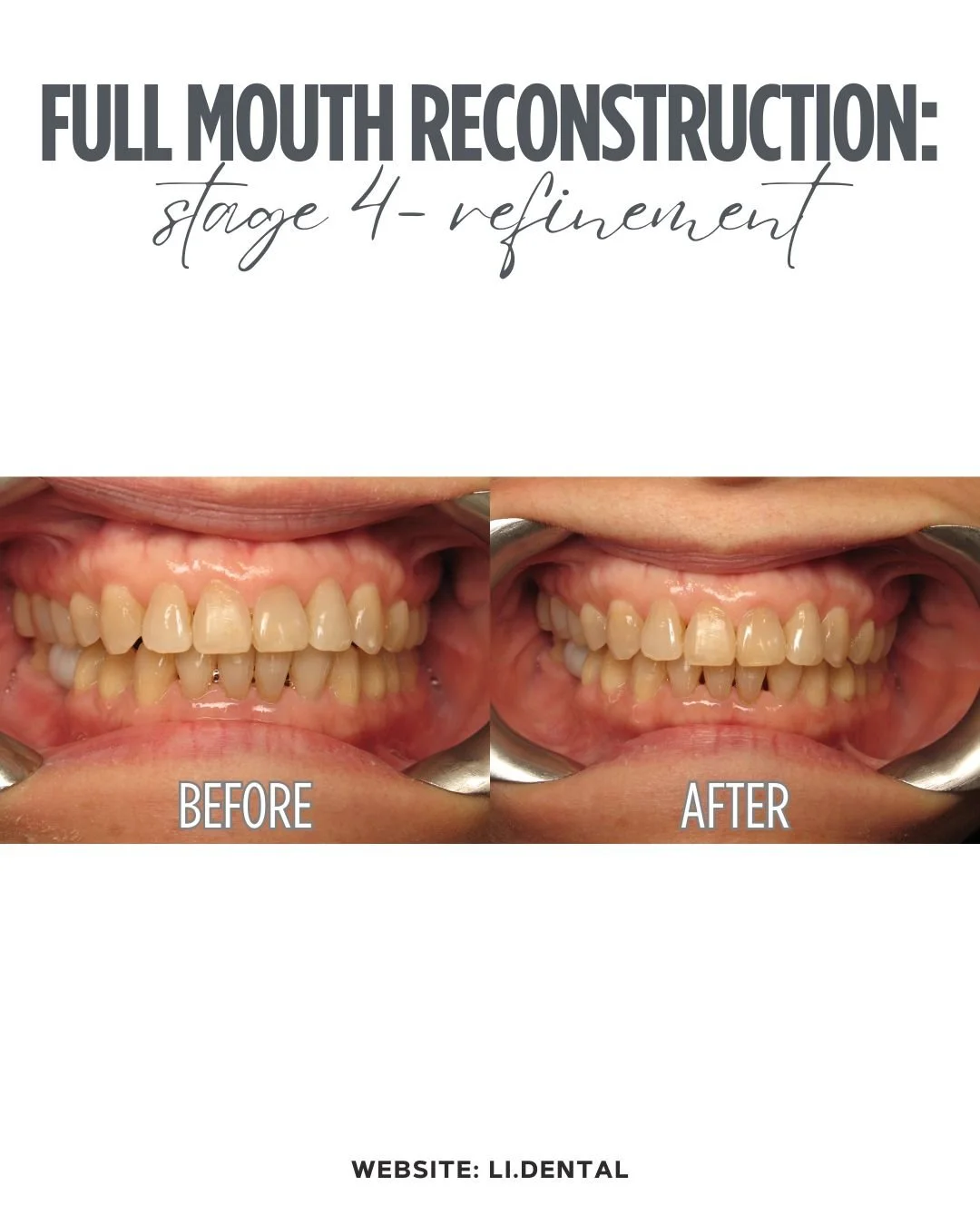 Stage 4 - Refinement:

The patient did 3 rounds of invisalign refinement to re-align bite relationship after restoration work. 

Take a look at the improvements in the bite!

❓ Stay tuned for our final Stage 5 - Enamelplasty.

Call us at 212-223-3005