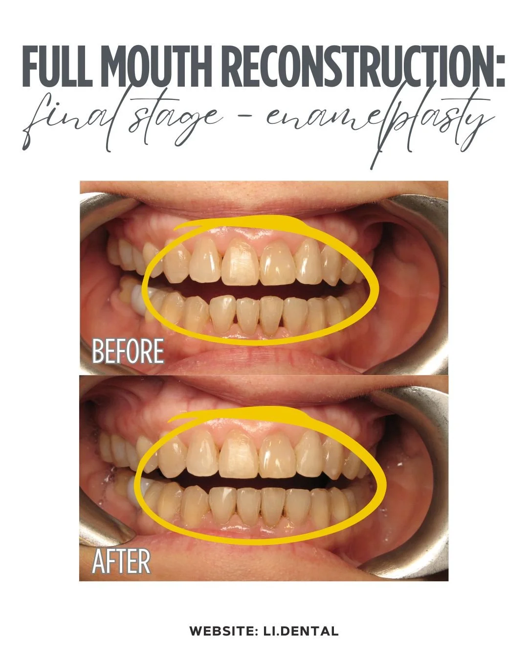 Stage 5 - Enameloplasty:
In the final stage of this 6 year case, the patient underwent enameloplasty to restore symmetry to her front teeth, resulting in a more even and beautiful smile. This concludes their journey through the five stages, from extr