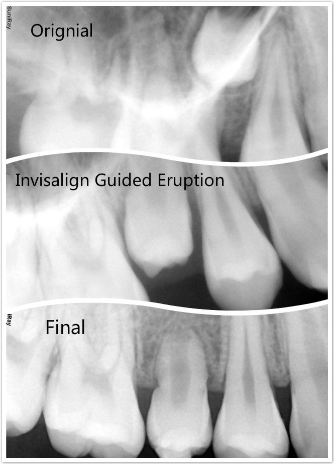 Invisalign Guided Eruption Before & After