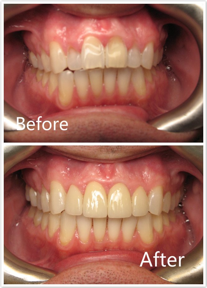 Veneers Before & After