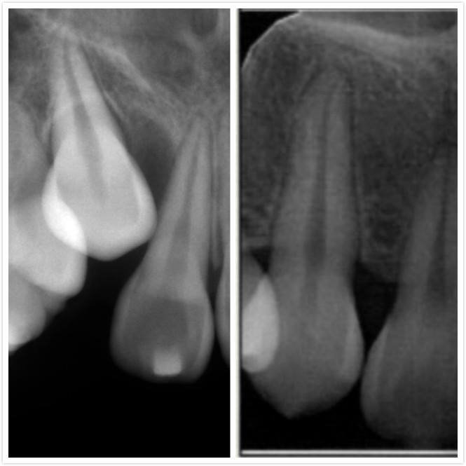 Invisalign Guided Eruption Before & After