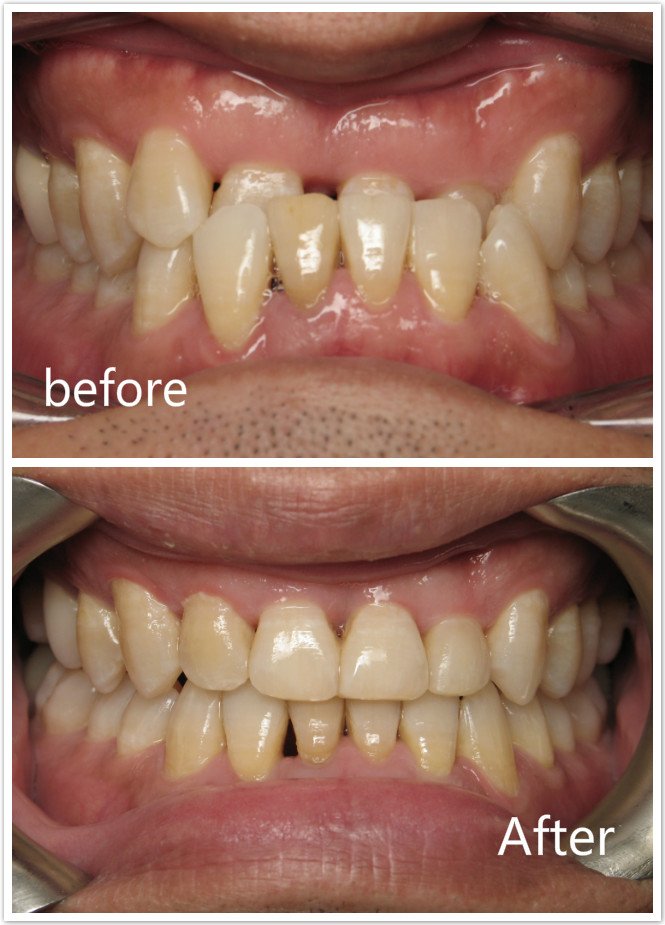 Crossbite Before & After