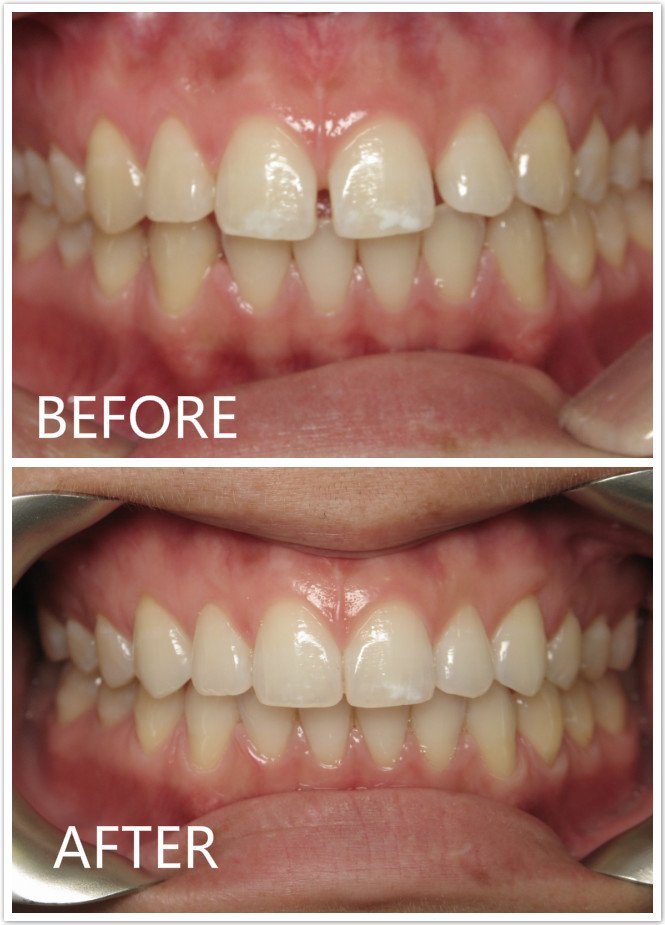 Front Teeth Space Before & After