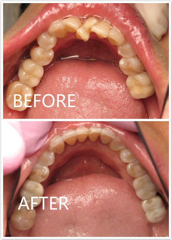 Teeth Crowding Before & After