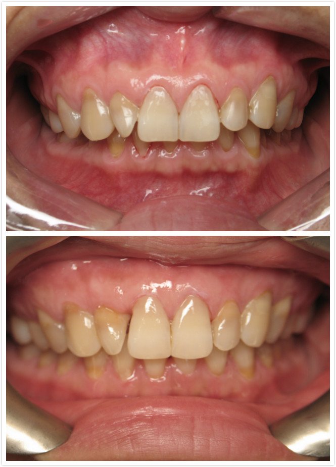 Deep Bite Before & After