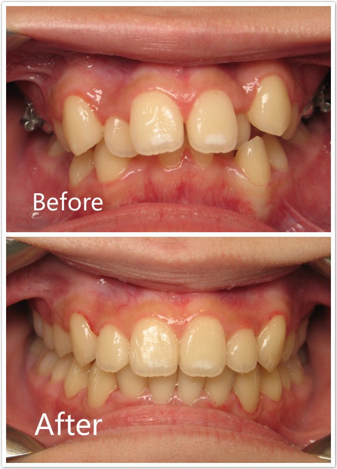 Teeth Crowding Before & After