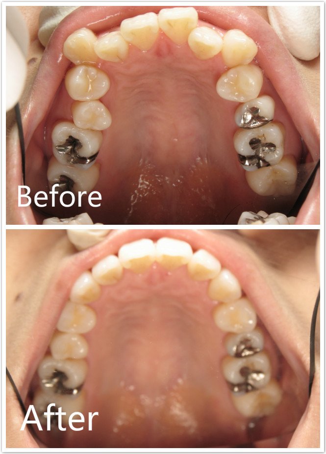 Teeth Crowding Before & After