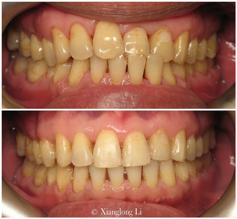 Crossbite Before & After