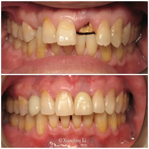 Invisalign® Case Shootout and Case Gallery Semi-Finalist 2015.jpg