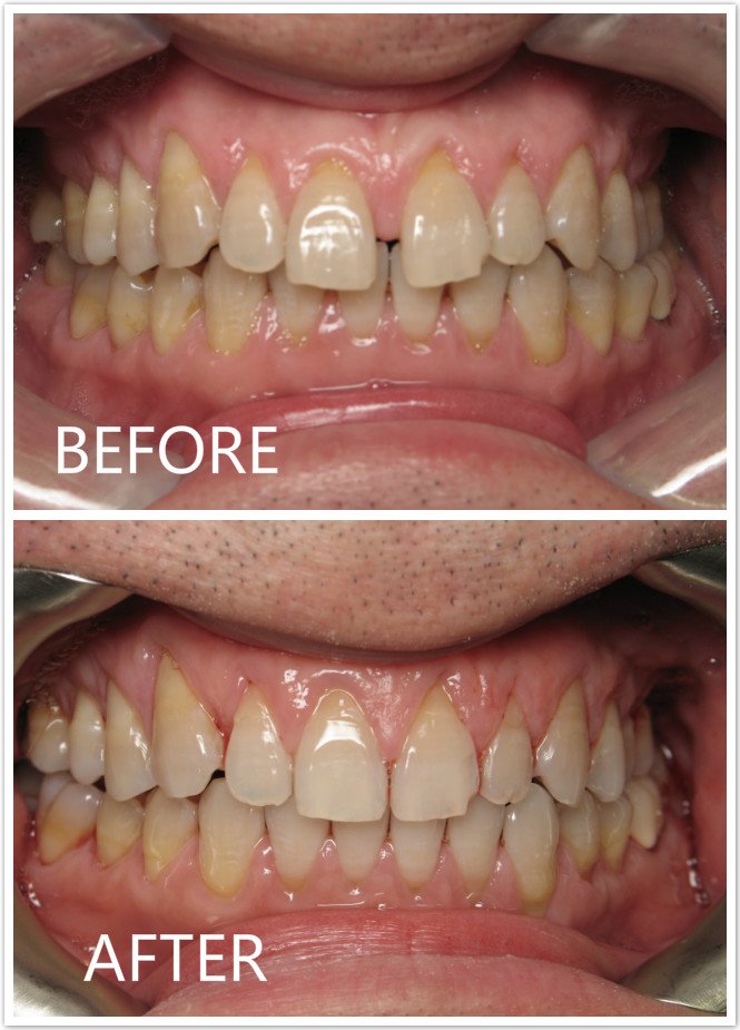 Front Teeth Space Before & After