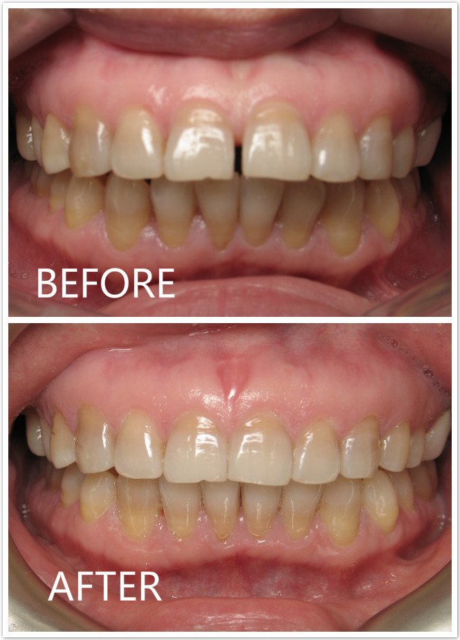 Front Teeth Space Before & After