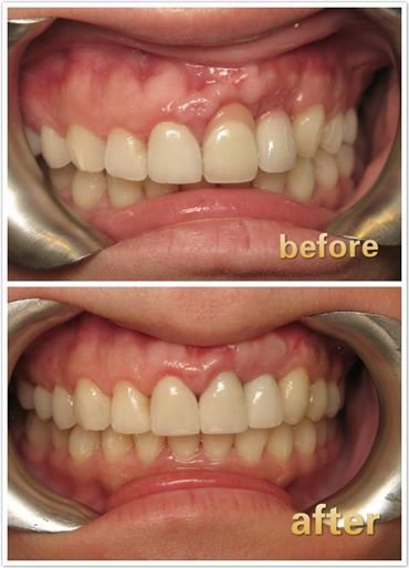 Central Teeth Redo Before & After