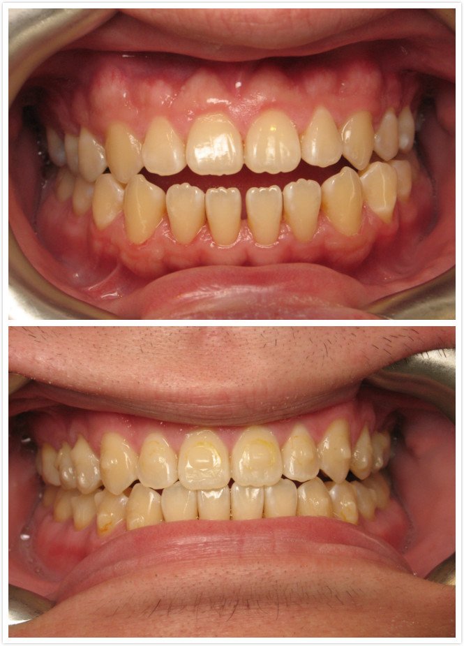 Open Bite Before & After