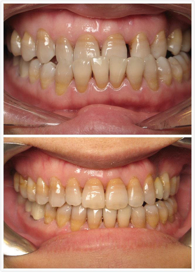Crossbite Before & After